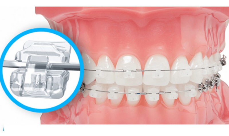 Hình  ảnh minh hoạ mắc cài sứ