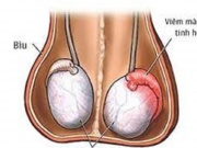 Sức khỏe đời sống - Viêm mào tinh hoàn có tự khỏi hay phải đến bệnh viện?