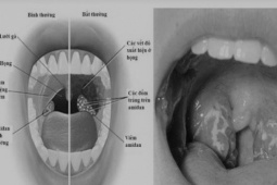 Sức khỏe đời sống - Sau khi cắt amidan có được ăn kem, uống nước ngọt?