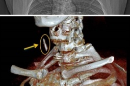 Sức khỏe đời sống - Hy hữu: Người đàn ông bị đinh sắt bắn vào cổ 15 năm mà không biết