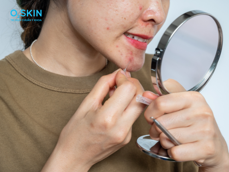 Bạn không nên tự ý nặn mụn bọc vì dễ để lại thâm sẹo trên da.