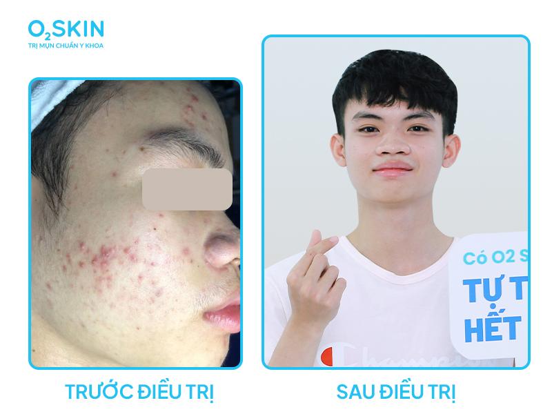Kiên trì và tuân thủ đúng hướng dẫn của bác sĩ là bí quyết giúp Minh Thuận giảm mụn rõ rệt.