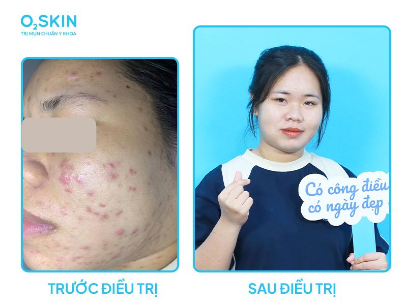 Kim Yến khuyến khích mọi người nên đến cơ sở da liễu uy tín để điều trị mụn.