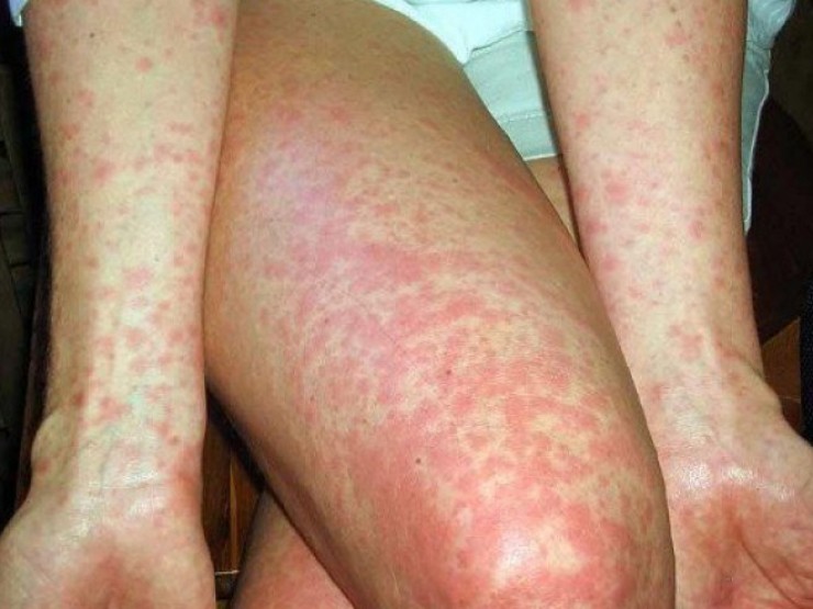 Số ca mắc sởi tăng nhanh, 7 yếu tố nguy cơ khiến bệnh diễn tiến nặng