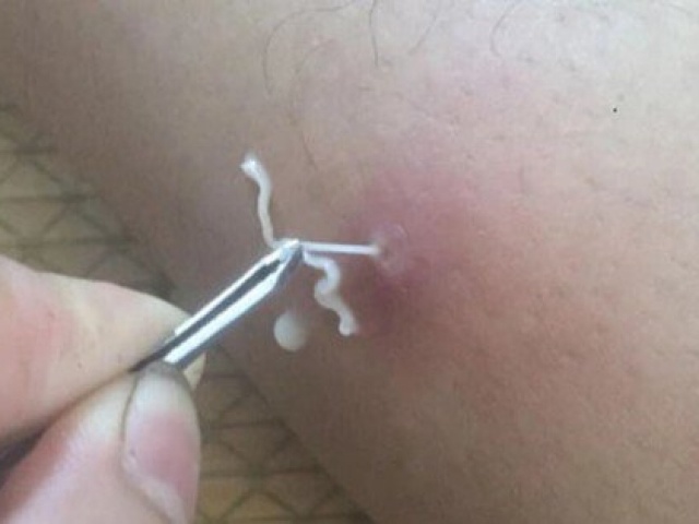 Bệnh do giun rồng tái xuất ở Việt Nam: ‘Sát thủ thầm lặng’ trở lại sau 20 năm