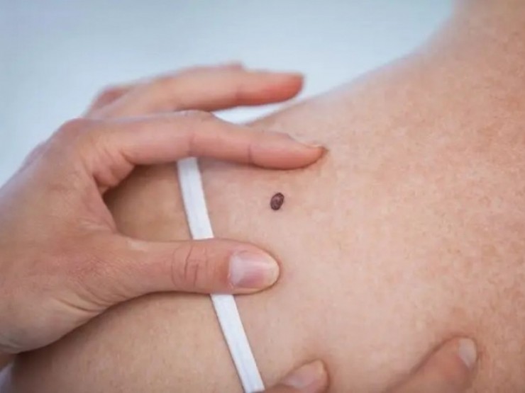 Nốt ruồi mọc ở 3 vị trí này có liên quan mật thiết đến ung thư, cần đi khám ngay