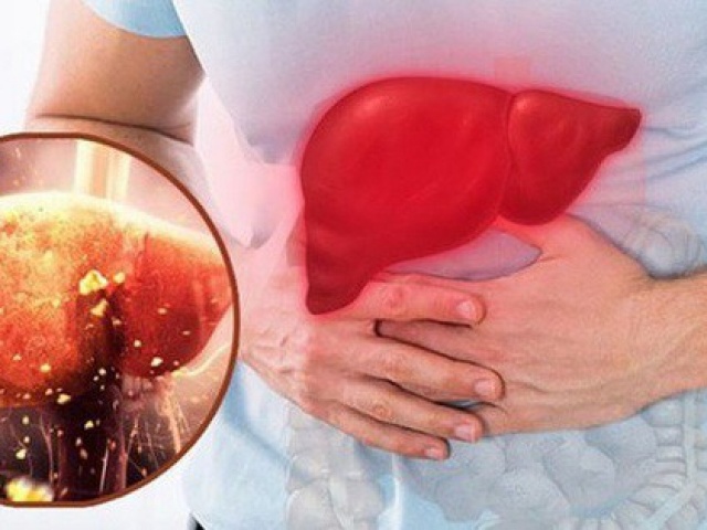 Người đàn ông có chỉ số men gan cao gấp 38 lần thừa nhận một sai lầm mà nhiều người Việt mắc phải