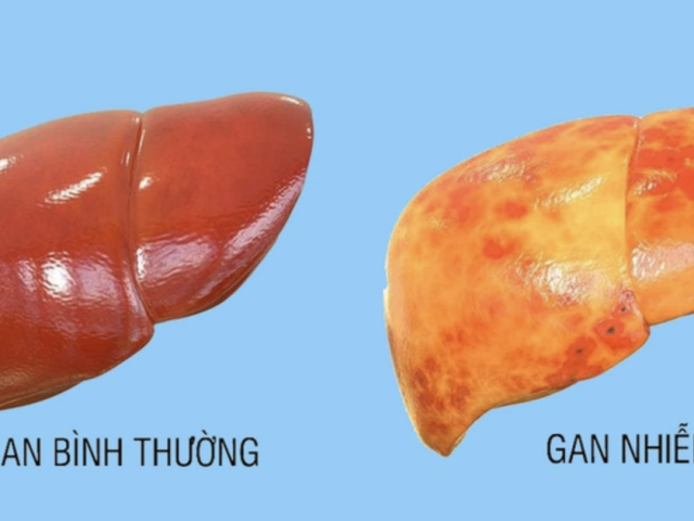 Những cách giúp ngăn ngừa gan nhiễm mỡ