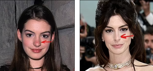 Anne Hathaway bị nghi phẫu thuật thẩm mỹ - 3