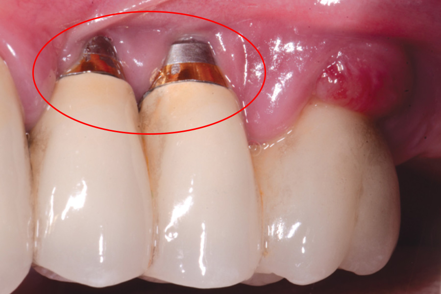 Implant bị đào thải, không tích hợp vào xương hàm