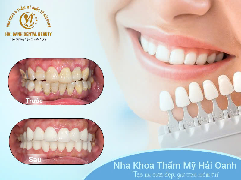 Ảnh trước và sau hoàn thiện răng sứ thẩm mỹ của khách hàng tại Nha khoa thẩm mỹ Hải Oanh