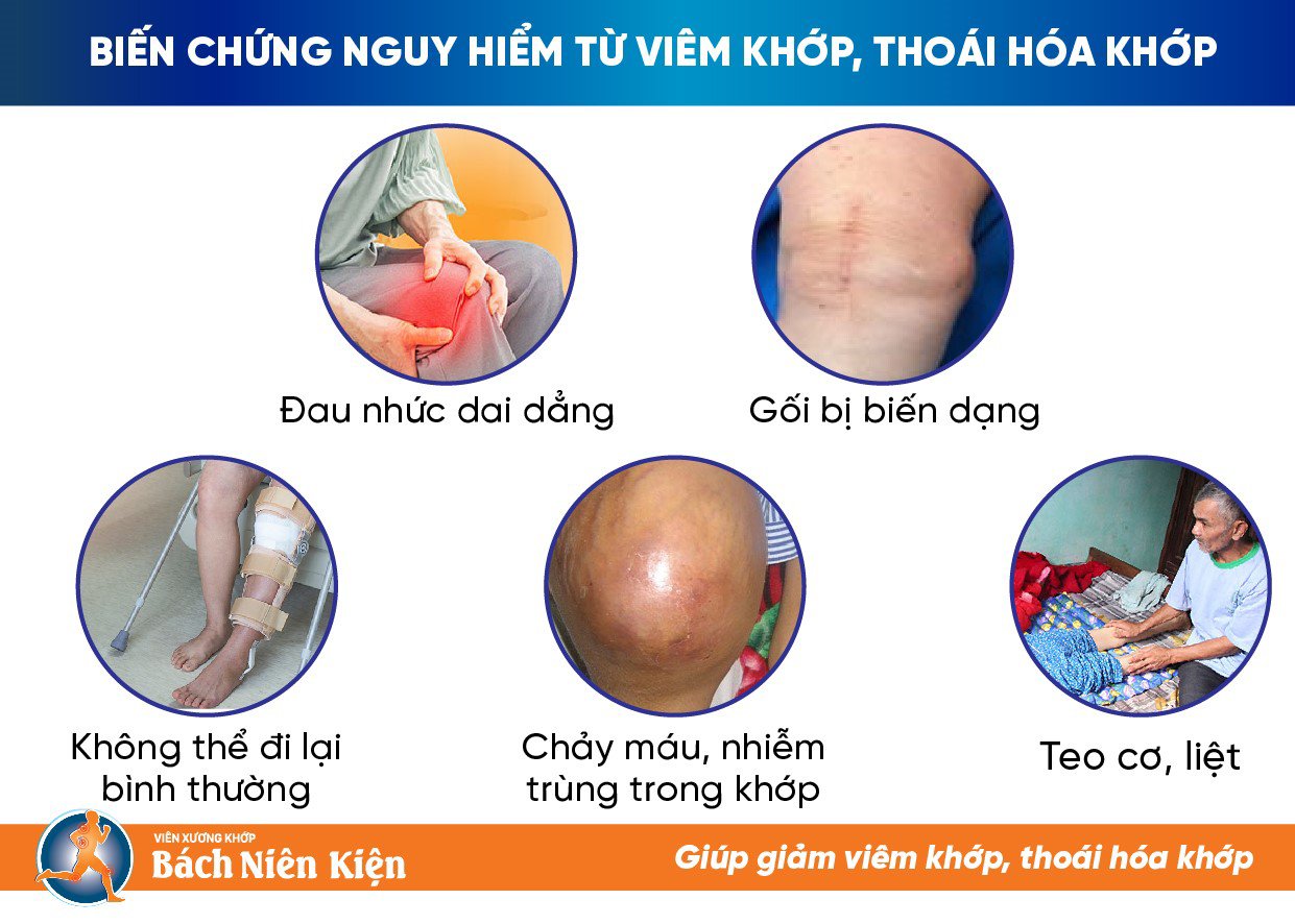 Thay đổi thời tiết &#39;tàn phá&#39; xương khớp: Cảnh báo nguy cơ tàn phế nếu người viêm khớp, thoái hóa khớp chủ quan! - 3