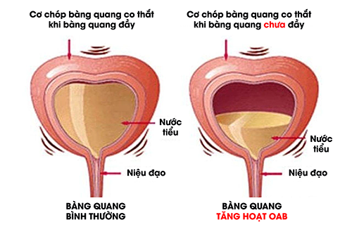 Thủ phạm gây tiểu đêm, tiểu nhiều lần - trên 40 tuổi rất hay mắc! - 3