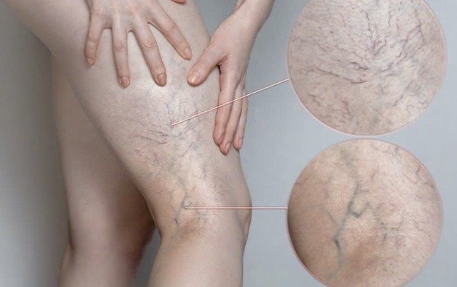 Căn bệnh cực kỳ nguy hiểm 1/3 người Việt trưởng thành có nguy cơ mắc, diễn biến âm thầm khó biết - 1