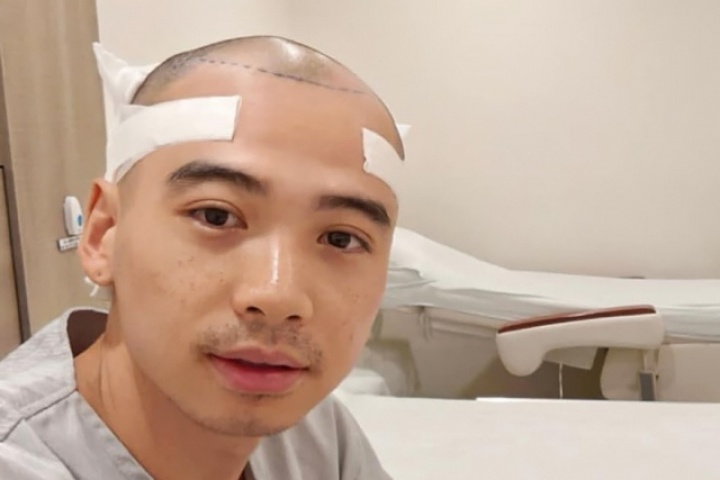 Chồng H'Hen Niê cấy tóc 'chống hói'