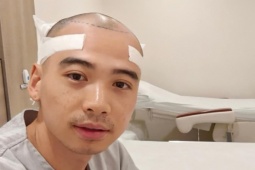 Chồng H ' Hen Niê cấy tóc  ' chống hói ' 