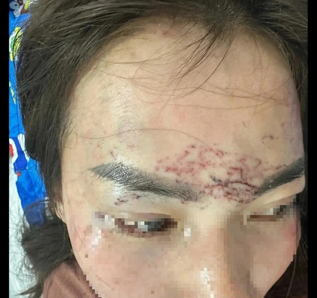 Vết thương trên vùng trán của bà M.