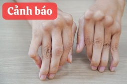 Tin tức sức khỏe - Đừng coi thường cơn đau khớp lúc trái gió trở trời – Có thể là dấu hiệu tàn phế sớm!