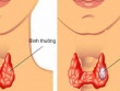 Người phụ nữ 60 tuổi cùng lúc mắc 2 thể ung thư tuyến giáp thừa nhận sai lầm nhiều người Việt mắc phải