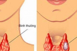 Người phụ nữ 60 tuổi cùng lúc mắc 2 thể ung thư tuyến giáp thừa nhận sai lầm nhiều người Việt mắc phải