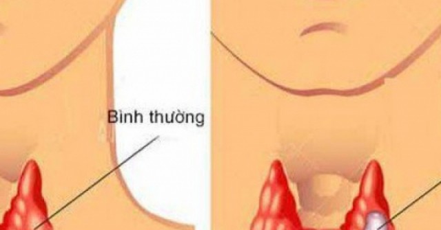 Người phụ nữ 60 tuổi cùng lúc mắc 2 thể ung thư tuyến giáp thừa nhận sai lầm nhiều người Việt mắc phải