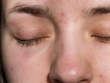 Vị trí nổi mụn cảnh báo vấn đề về gan