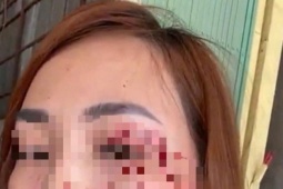 Khởi tố vụ một phụ nữ ở Nha Trang  " bị người không quen biết rạch mặt " 