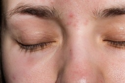 Vị trí nổi mụn cảnh báo vấn đề về gan