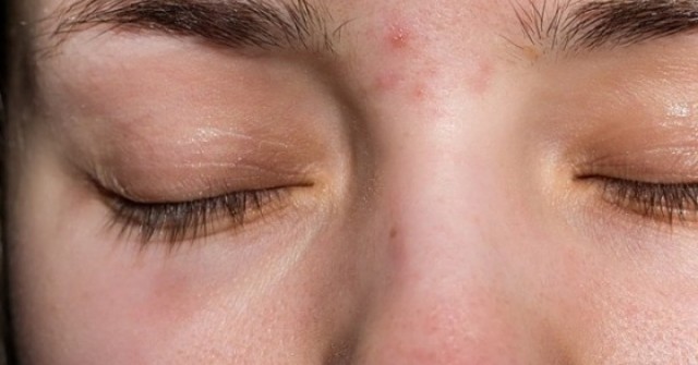 Vị trí nổi mụn cảnh báo vấn đề về gan