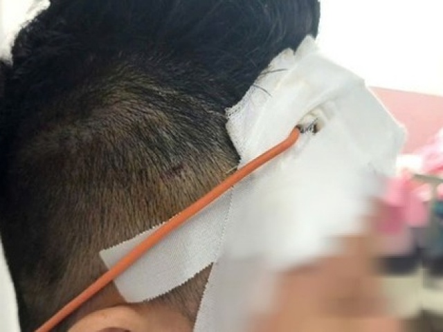 Ngã xe máy, một tháng sau mới lộ chấn thương sọ não