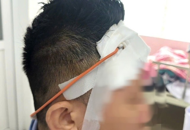 Bệnh nhân được phát hiện có khối máu tụ lớn chèn ép não trái sau vụ tai nạn