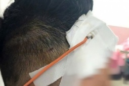 Ngã xe máy, một tháng sau mới lộ chấn thương sọ não