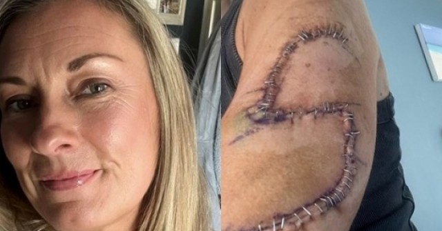 Phát hiện ung thư da từ một nốt ruồi