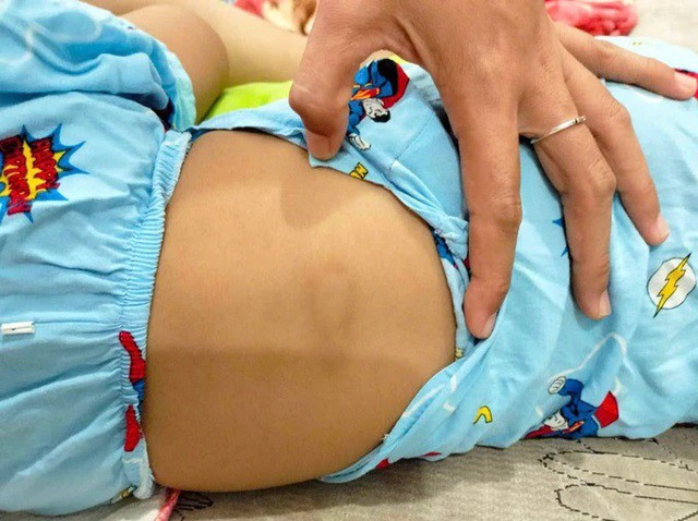 Vết bầm tím trên lưng cháu A. nghi bị bạo hành. Ảnh: B.T