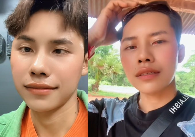 Sau phẫu thuật (bên phải), nhãn cầu của Lai Thai cân đối hơn, cải thiện phần nào tình trạng lác trong (lòng đen chủ yếu hướng về phía khóe mắt).