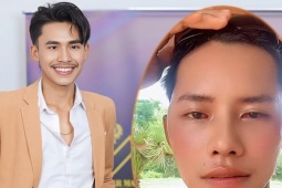Thí sinh Nam vương Campuchia phẫu thuật chỉnh mắt lé