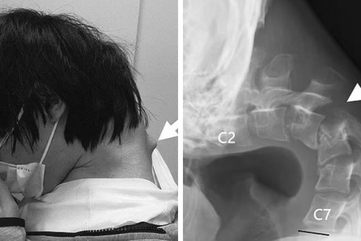 Cổ của chàng trai bị biến dạng.