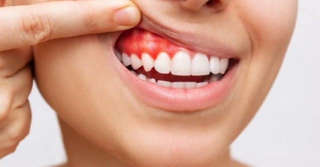 Bí Quyết Răng Miệng Khỏe Mạnh: Chìa Khóa Cho Sức Khỏe Toàn Diện