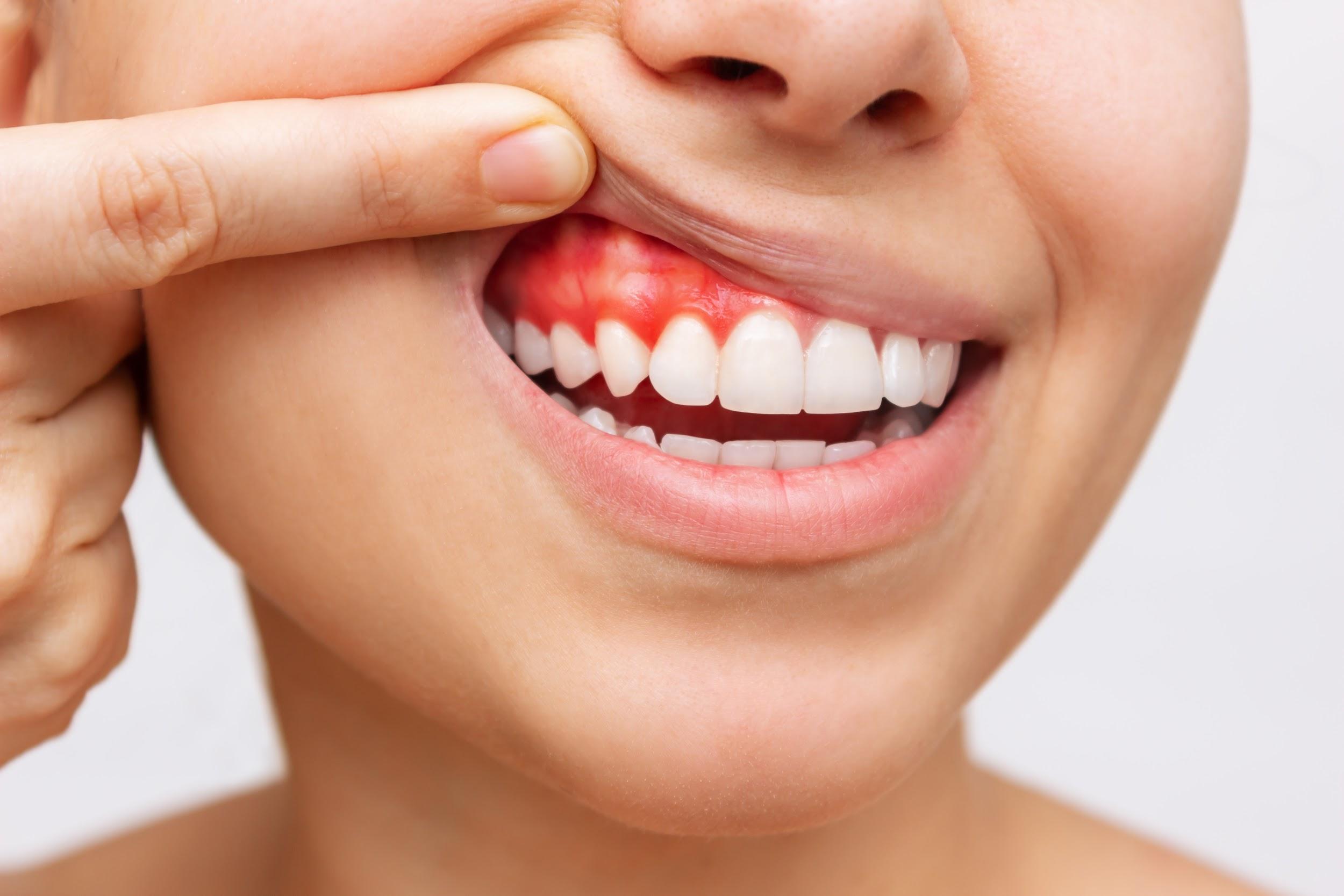 Chăm sóc răng miệng không đúng cách dẫn đến các bệnh lý răng miệng như sưng nướu/lợi, viêm nha chu, áp xe răng