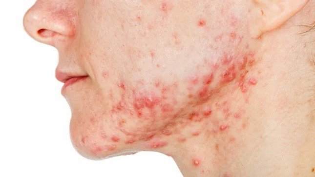 Trong một thử nghiệm lâm sàng, các nhà khoa học đang nghiên cứu xem liệu vắc xin có thể điều trị cho những bệnh nhân bị mụn trứng cá ở mặt từ trung bình đến nặng hay không. (Ảnh: Obencem)