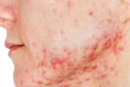 Sắp có vắc xin ngừa mụn trứng cá