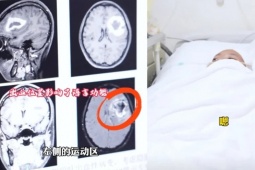 Cô gái bỗng dưng " quên " tiếng Anh: Bác sĩ phát hiện nguyên nhân bất ngờ