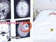 Cô gái bỗng dưng "quên" tiếng Anh: Bác sĩ phát hiện nguyên nhân bất ngờ