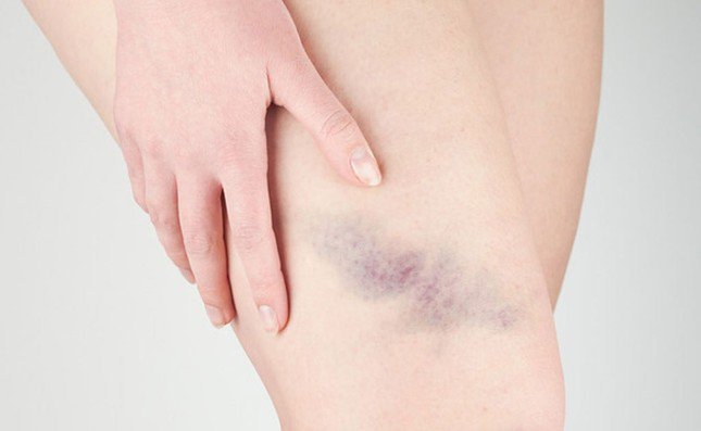 Vết bầm tím không rõ nguyên nhân là một trong những dấu hiệu của bệnh xuất huyết giảm tiểu cầu miễn dịch. Ảnh minh họa: Internet
