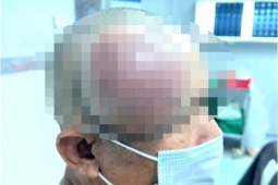 Phẫu thuật thành công khối u to như cái chén ở đầu bệnh nhân