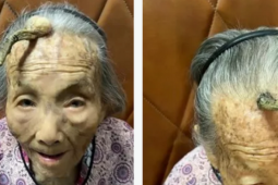 Cụ bà 107 tuổi bỗng mọc  " sừng "  trên trán, cộng đồng mạng bàn tán đưa ra lời khuyên