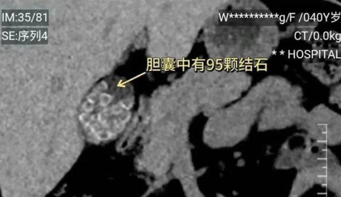 Ảnh chụp những viên sỏi trong túi mật người phụ nữ ở Phúc Kiến, Trung Quốc. Ảnh: QQ