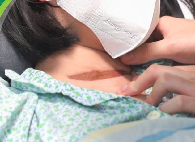 Hình ảnh vết thương trên cổ của bé gái do bị cửa cuốn kẹp vào cổ