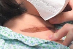 Bị cửa cuốn tại nhà kẹp cổ, bé gái 11 tuổi ngừng tuần hoàn, nguy kịch