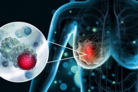 12 kiểu phụ nữ dễ bị ung thư vú